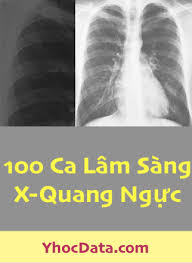 100 Ca Lâm Sàng X-Quang ngực